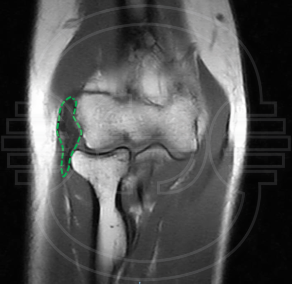 CIRUGIA de la EPICONDILITIS y la EPITROCLEITIS: Imagen de resonancia magnética de codo de paciente con epicondilitis donde se aprecia tendinosis del origen común de la musculatura extensora en el epicóndilo humeral (delimitado por punteado verde).