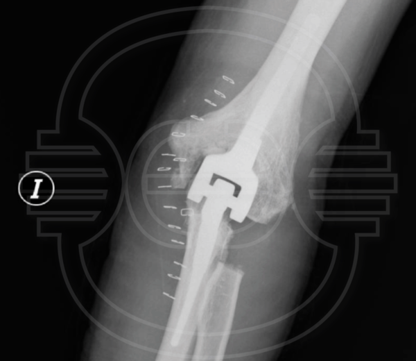 CIRUGIA de la ARTROSIS en el CODO: Radiografia AP de codo con prótesis implantada