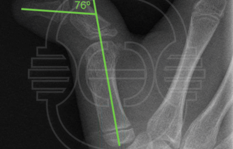 Radiografía anteroposterior de mano preoperatoria.