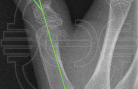 Radiografía anteroposterior de mano un año después de la cirugía.
