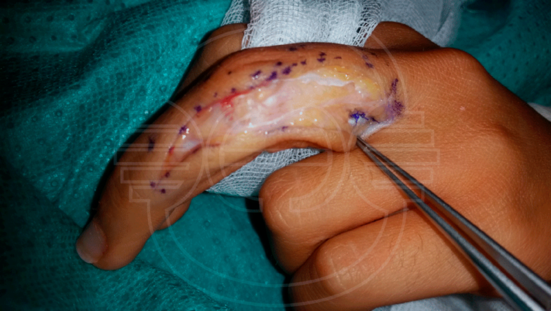 CIRUGIA de las DEFORMIDADES de los DEDOS: Imagen intraoperatoria de cirugía de reconstrucción del aparato extensor y sistema retinacular en dedo con deformidad en cuello de cisne.