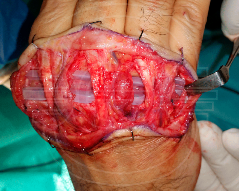 CIRUGIA de las ENFERMEDADES REUMATICAS: Imagen intraoperatoria de cirugía de sustitución de articulaciones metacarpofalángicas por prótesis de silicona por artritis reumatoide.