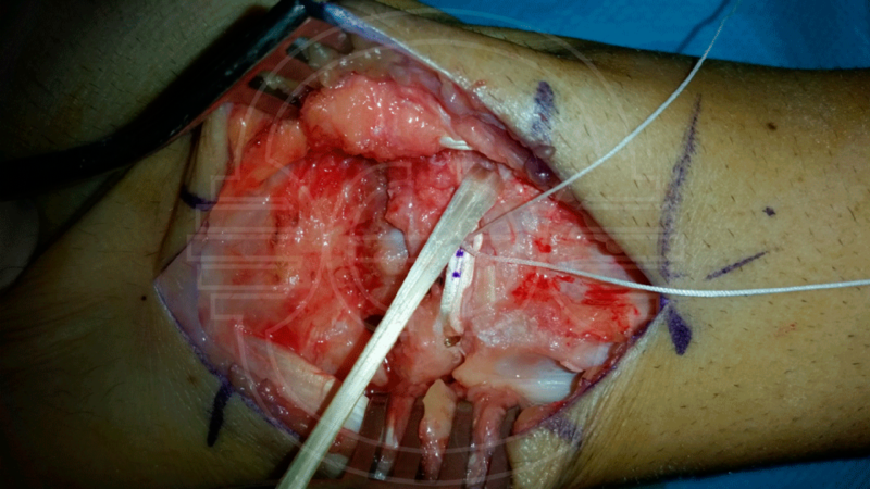 CIRUGIA de la INESTABILIDAD del CARPO: Imagen intraoperatoria de ligamentoplastia “3LT” por inestabilidad escafolunar.