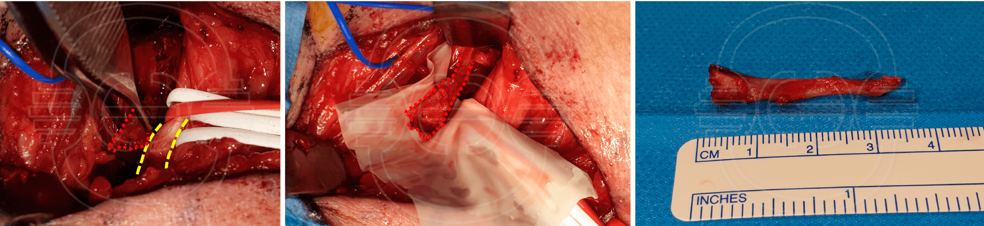 CIRUGÍA de la PARALISIS del PLEXO BRAQUIAL del ADULTO: Neurolisis de tronco inferior del plexo braquial (punteado amarillo) por síndrome de compresión en desfiladero torácico por costilla cervical (punteado en rojo) que es resecada.
