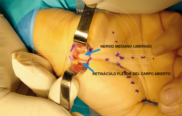 CIRUGIA del SINDROME del TUNEL CARPIANO: Imagen intraoperatoria de cirugía de liberación del nervio mediano en el túnel carpiano.